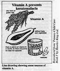 Vitamin A prevents keratomalacia.