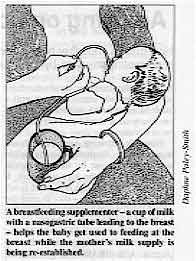 A breastfeeding supplementer -a cup of milk with a nasogastric tube leading to the breast -helps the baby get used to feeding at the breast while the mother's milk supplp is being re-established. 