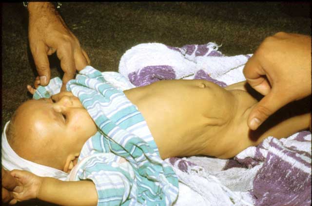 Slide 4 - Dehydration is demonstrated in this infant by the 'tenting' of the skin over the right side of the child's abdomen caused by the pinch of the examiner's fingers seen withdrawing to the right.
